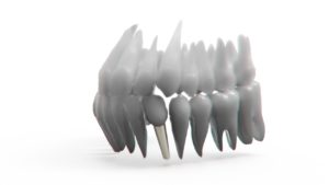 Zahnersatz Implantat