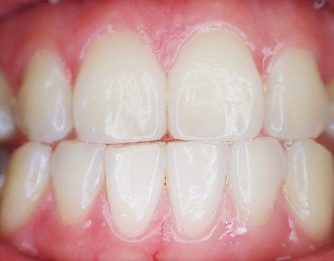 Zahnimplantate – Wissenswertes